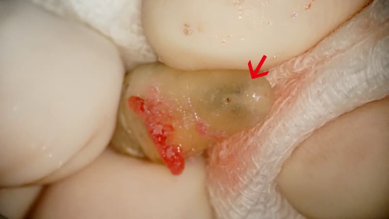 Root Inflammation Discovery