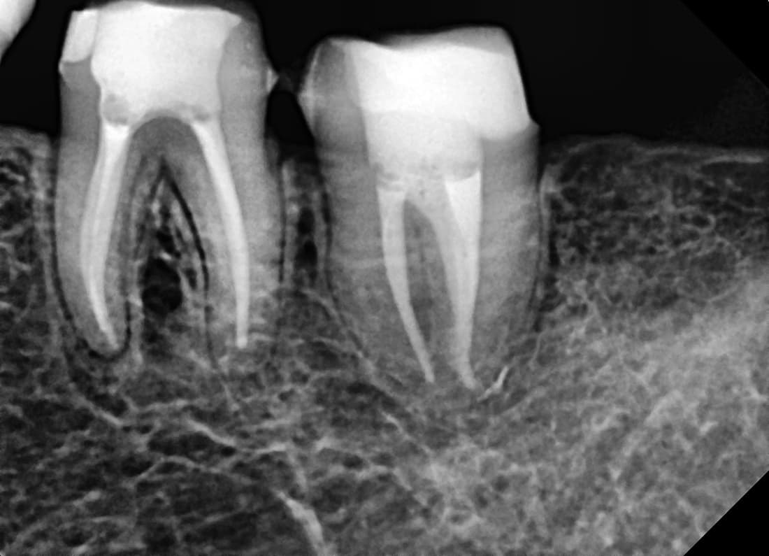 1 year 2 months after treatment