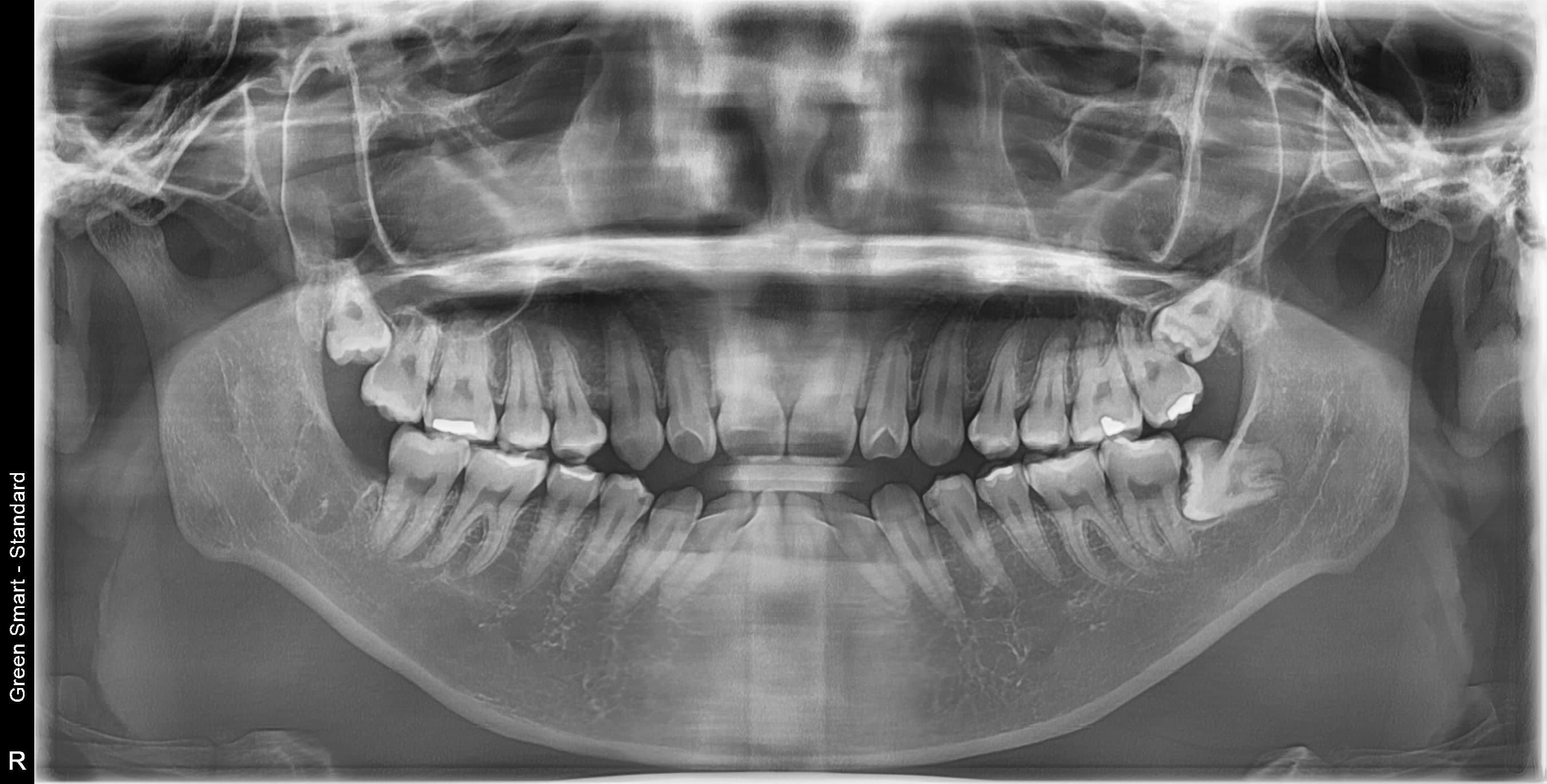 치근만곡 사랑니 - 발치 후