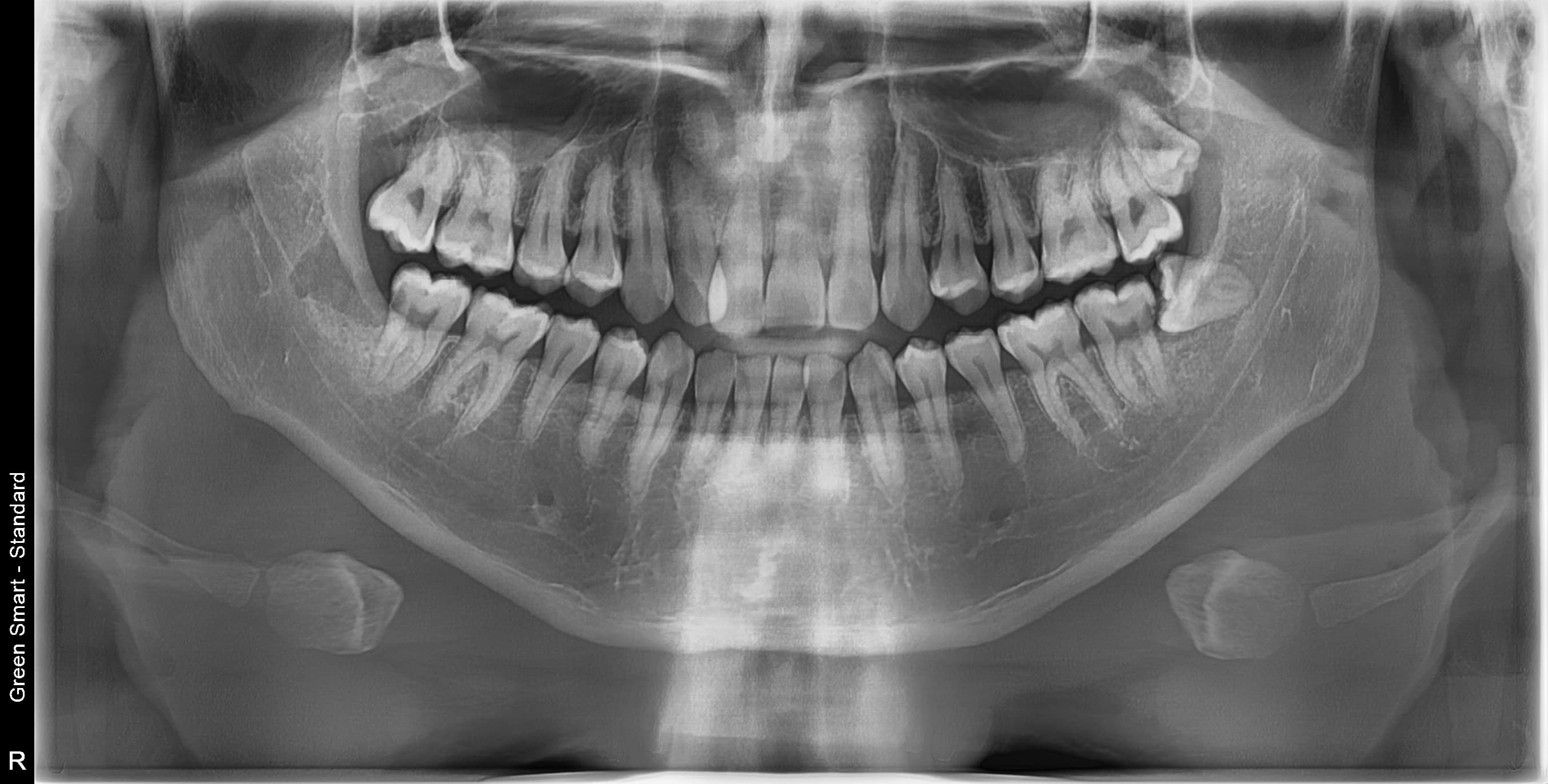 수평매복 사랑니 - 발치 후
