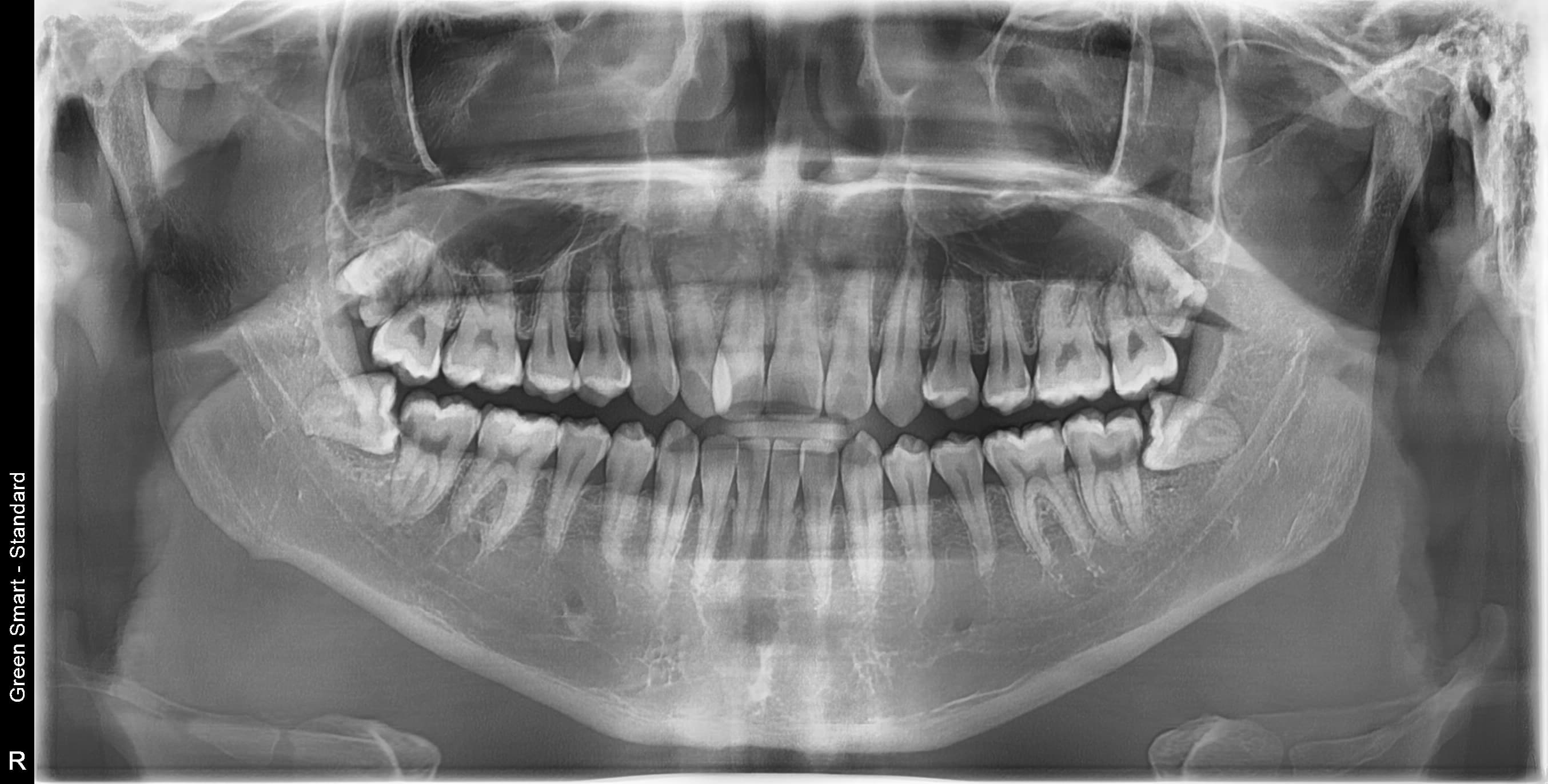 수평매복 사랑니 - 발치 전