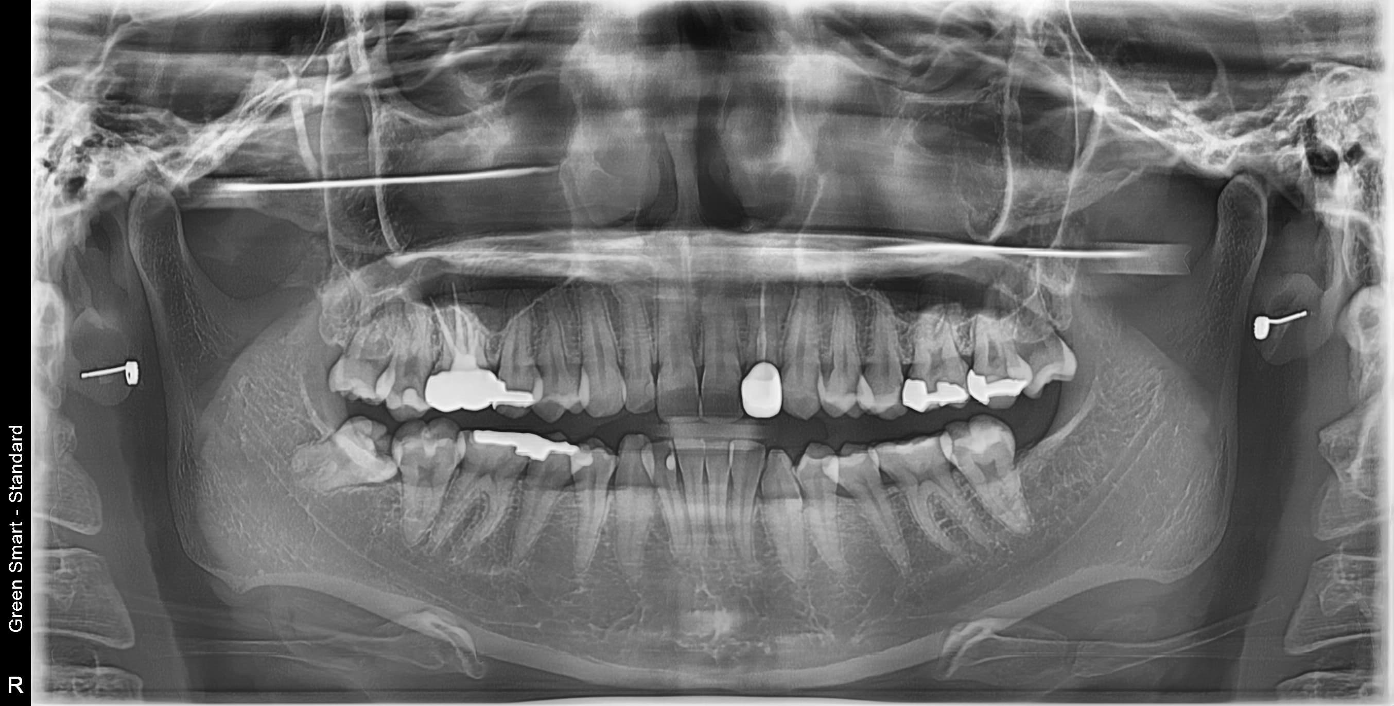 부분매복 사랑니 - 발치 전
