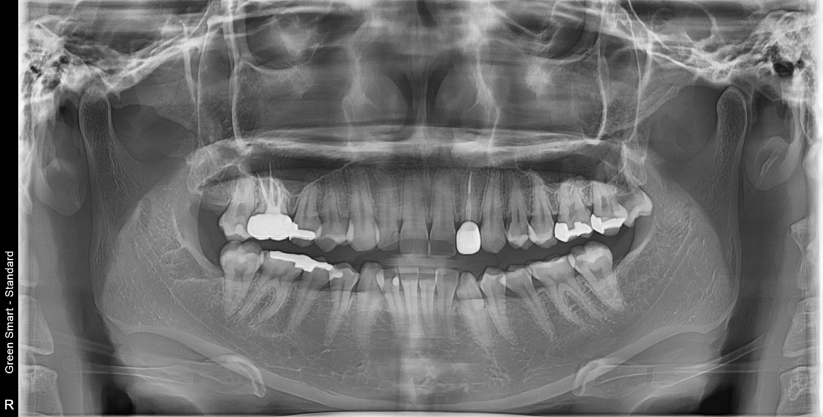 부분매복 사랑니 - 발치 후