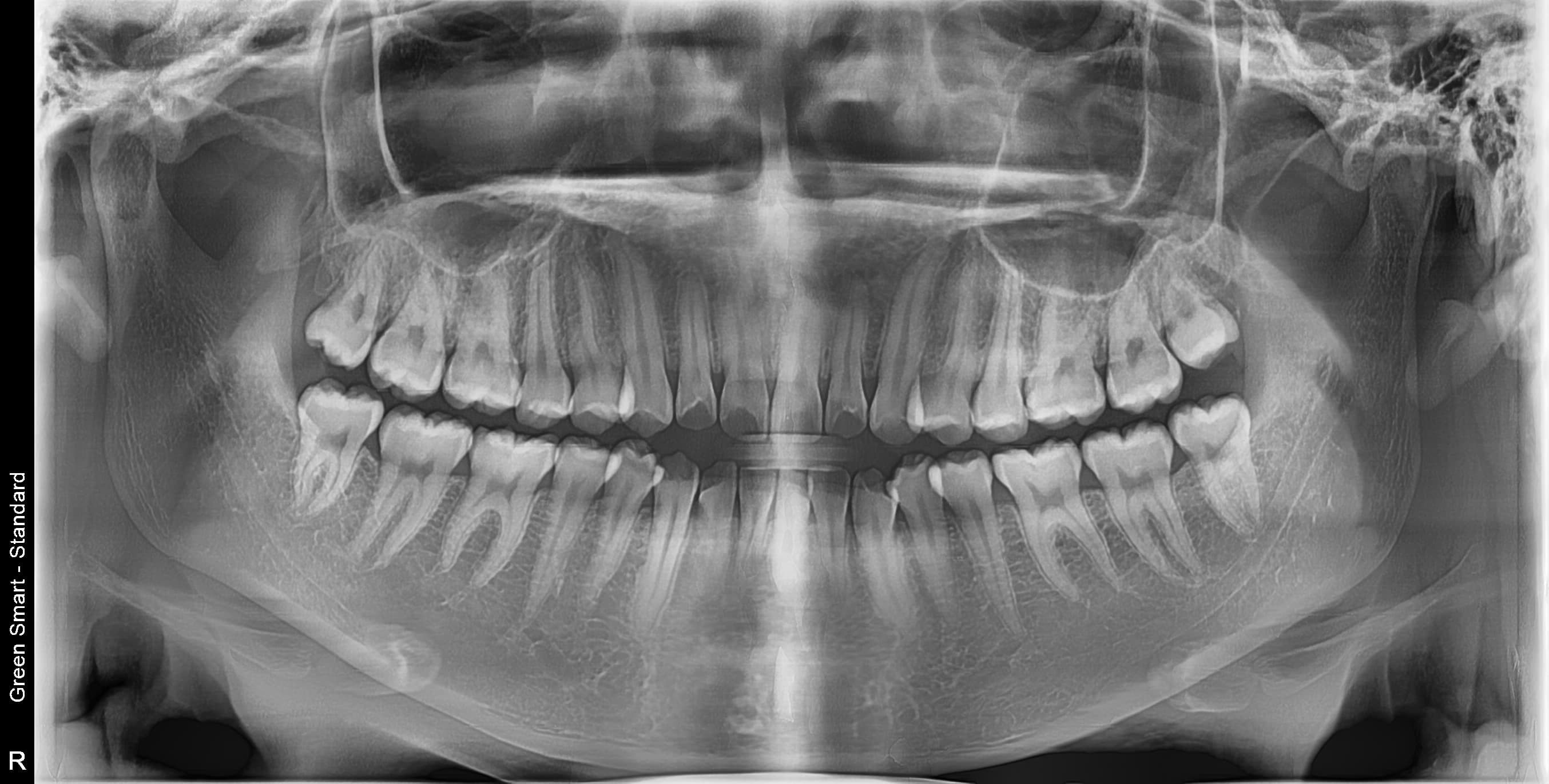 정상 사랑니 - 발치 전