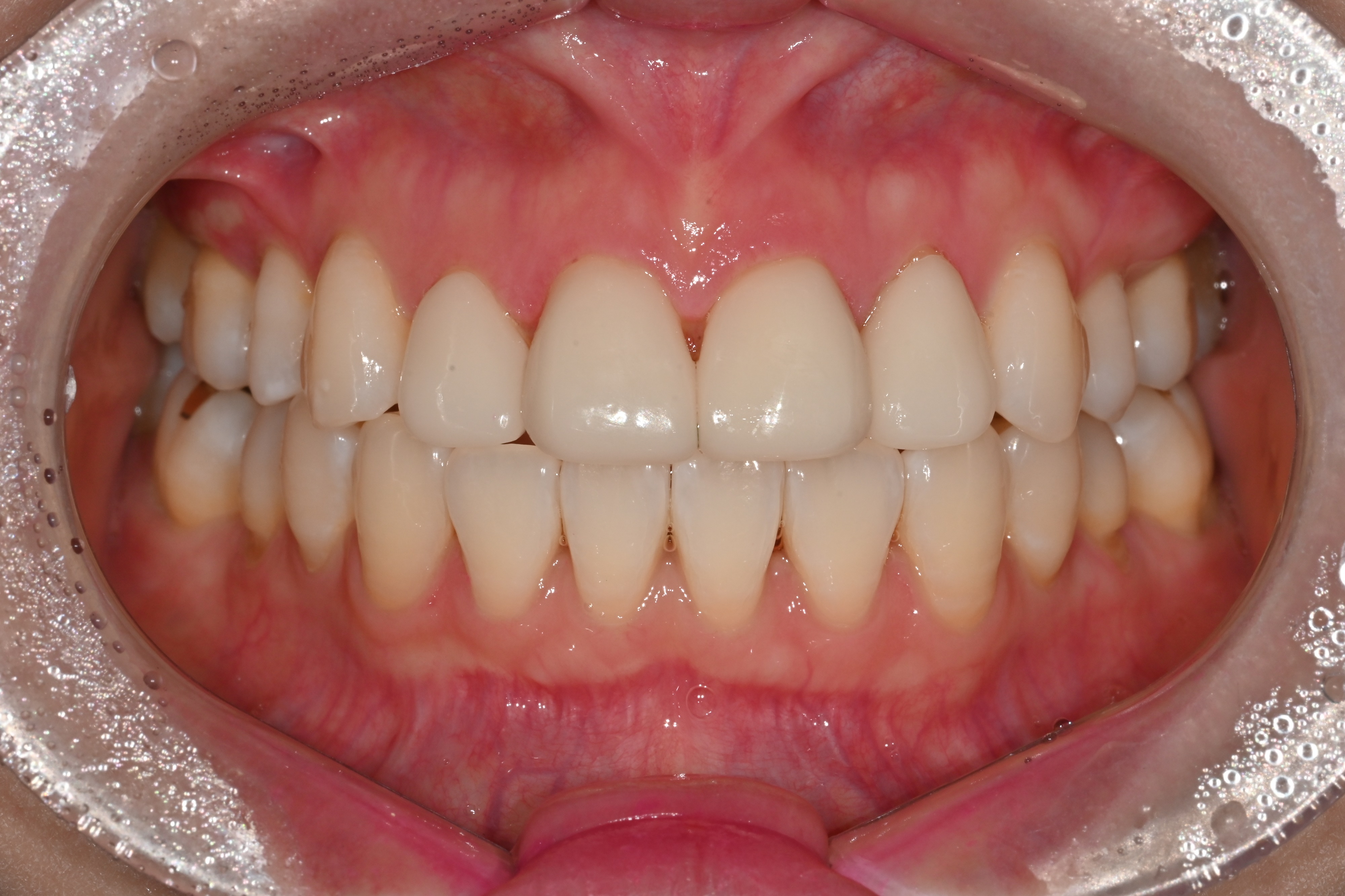 라미네이트 After