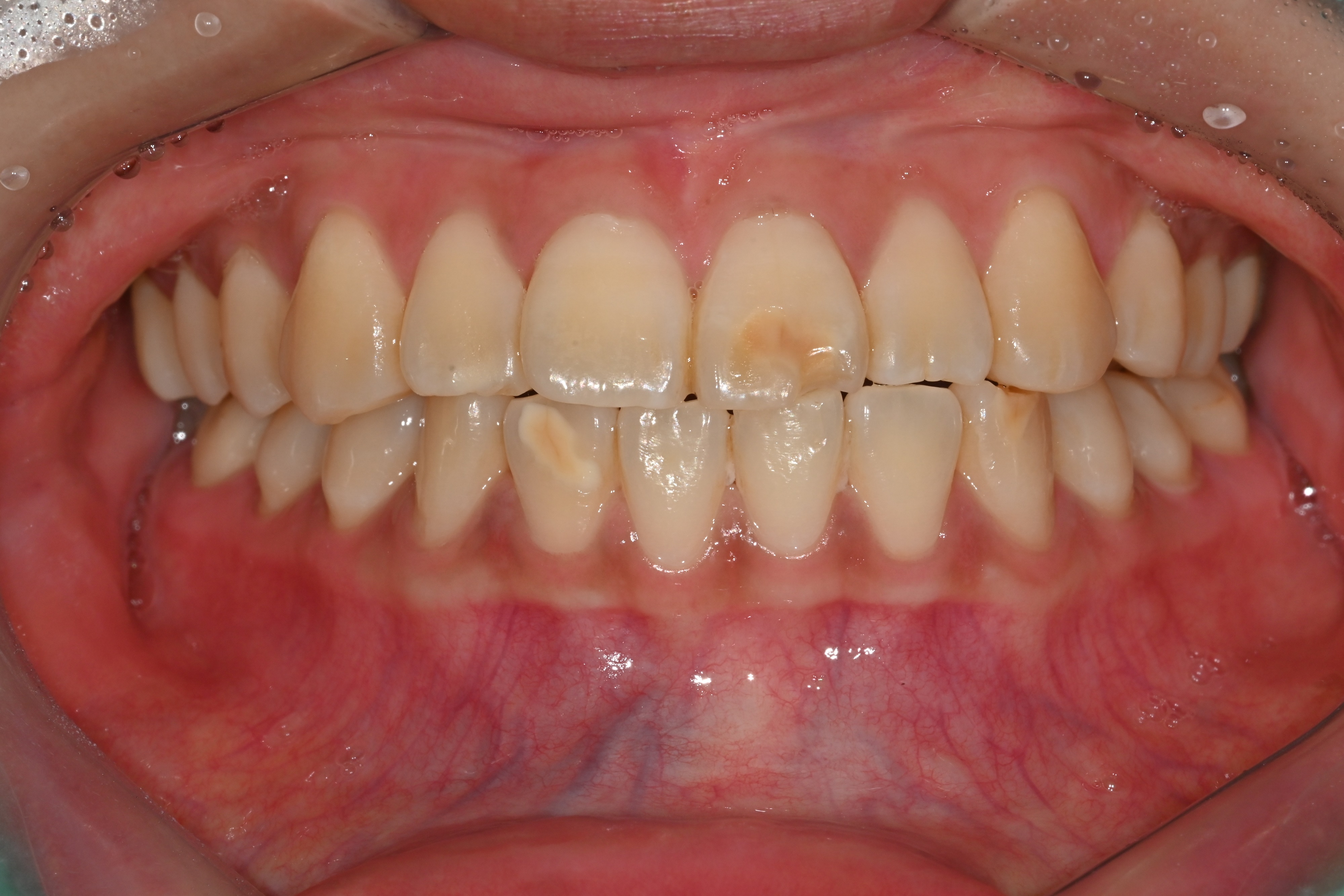 라미네이트 Before