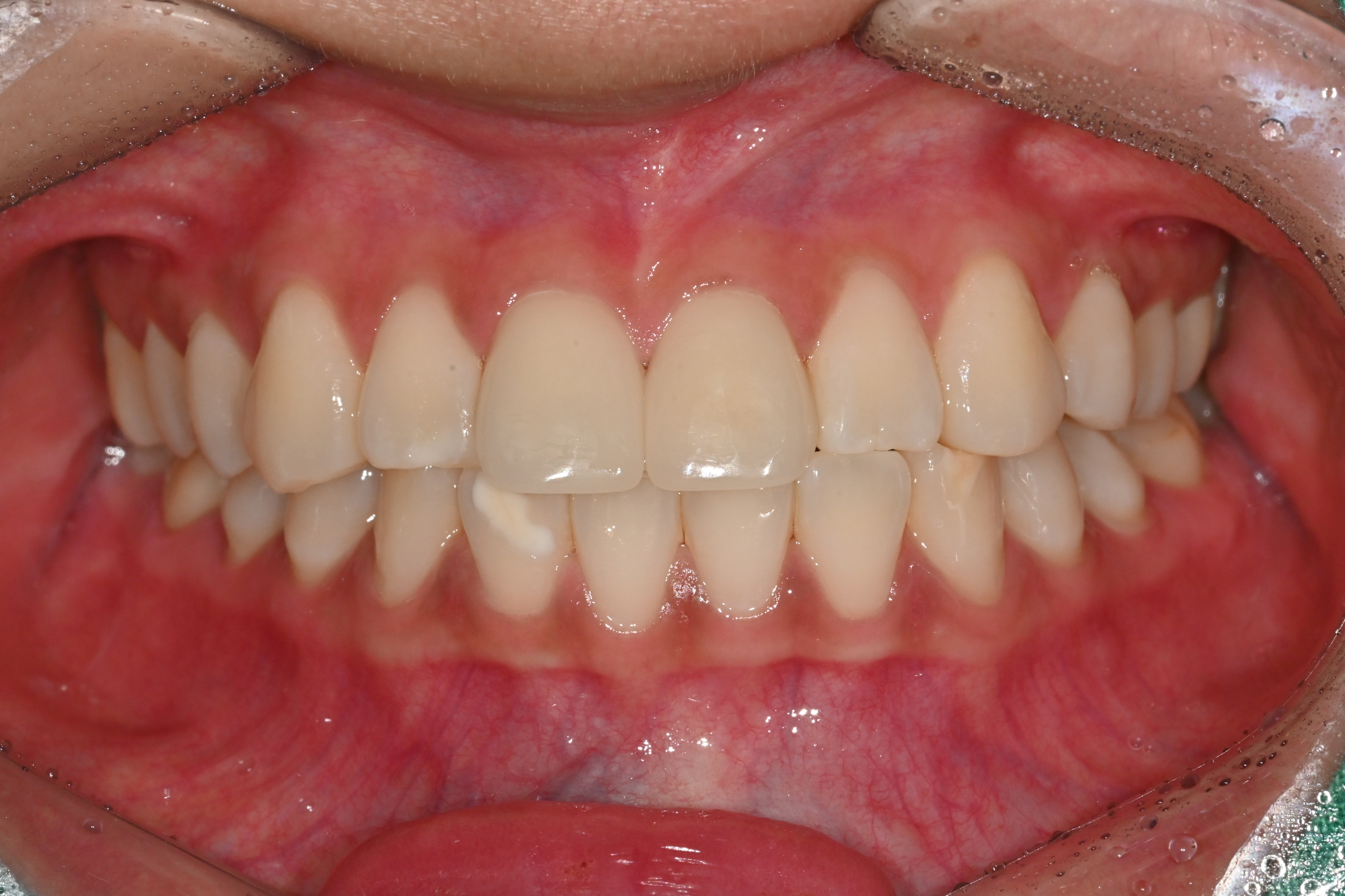 라미네이트 After