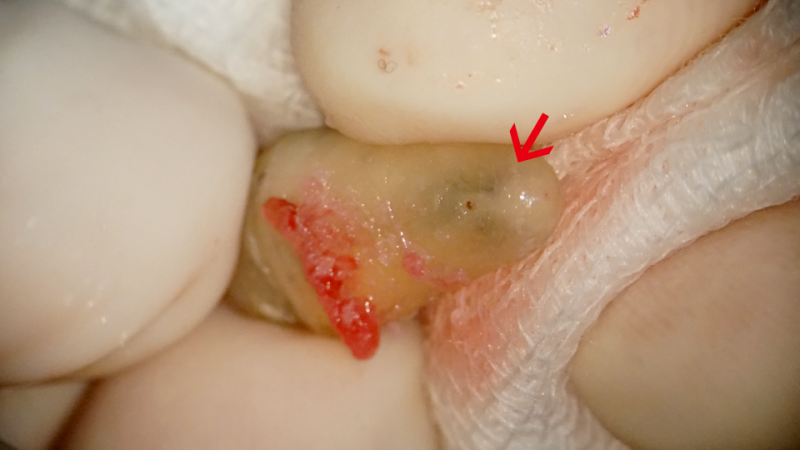 치아 뿌리 염증 원인 발견