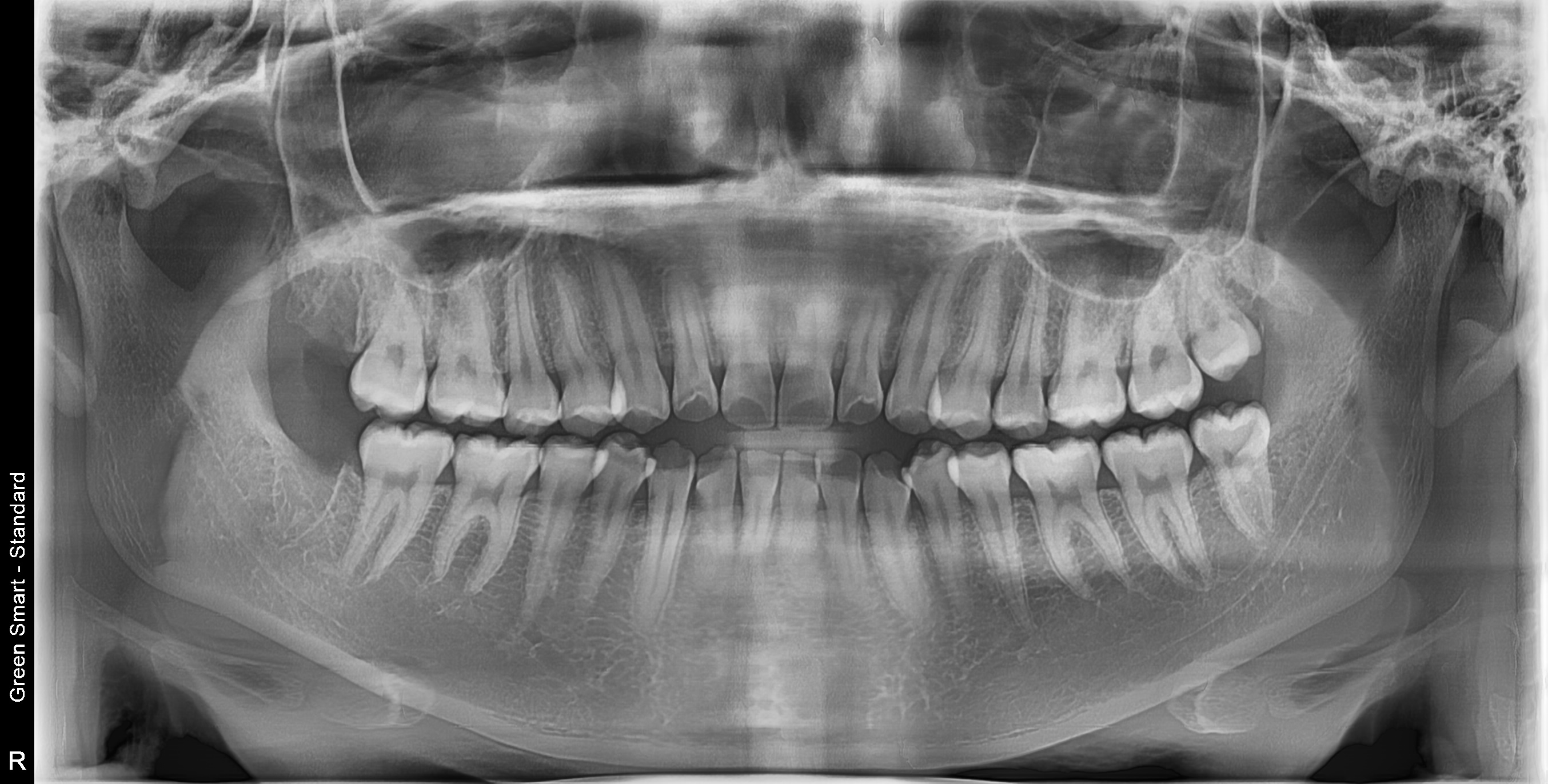 정상 사랑니 - 발치 후