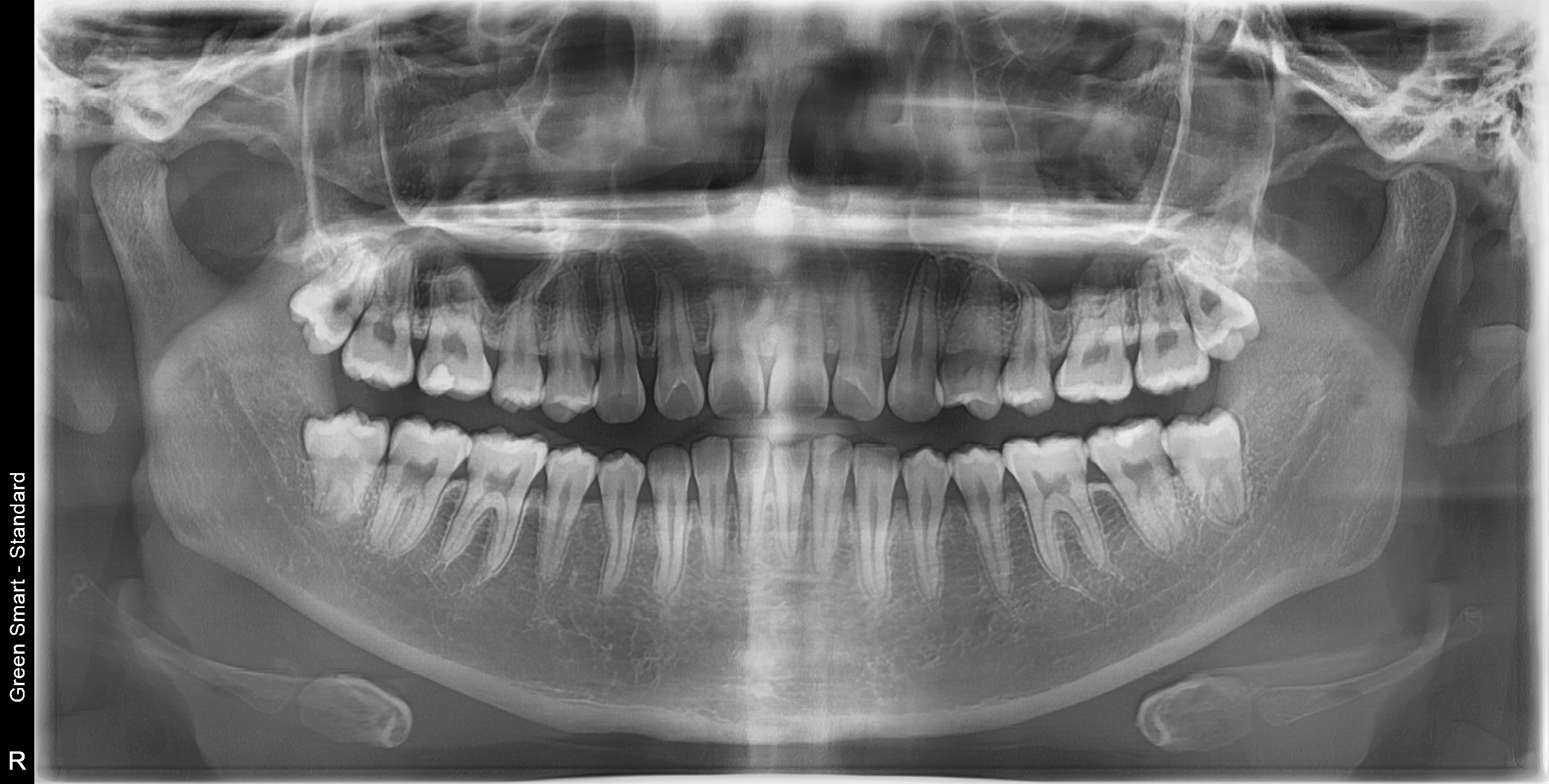 완전매복 사랑니 - 발치 전