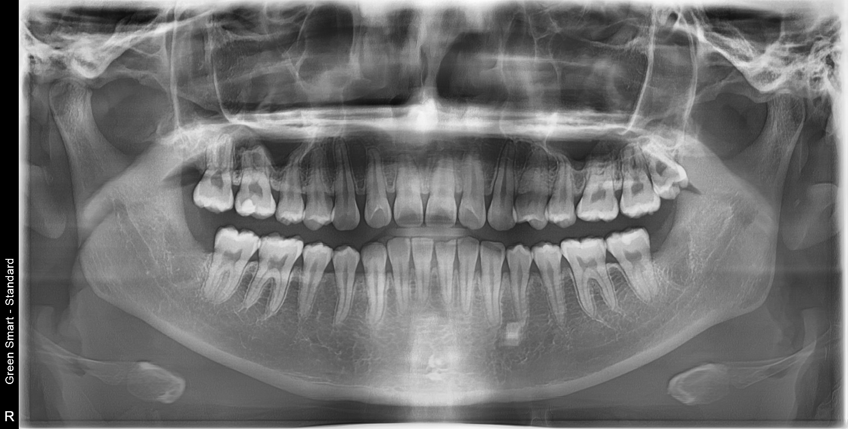 완전매복 사랑니 - 발치 후